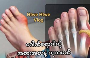 ဂေါက်ရောဂါ ကို အစားအစာနဲ့ ကုမယ်