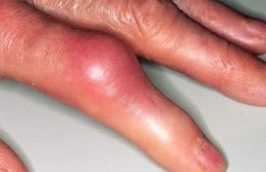 လူတို့ကို ဒုက္ခပေးတတ်သော ဂေါက်ရောဂါ (gout)